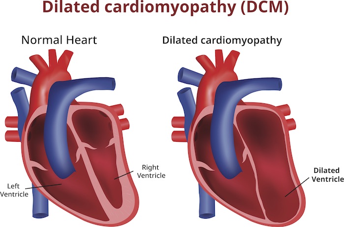 Q10 heart disease children